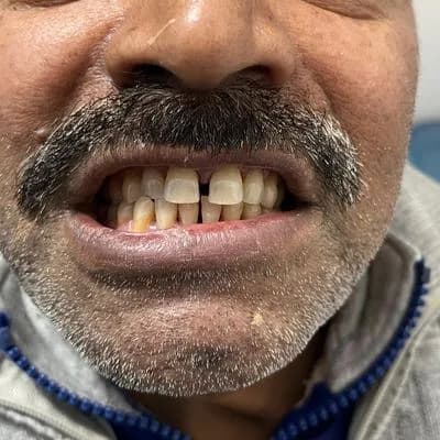 Cosmetic Dentistry Before Case Study