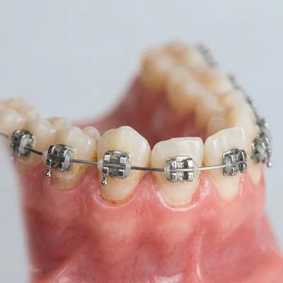 Braces & Aligners Before Case Study