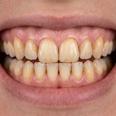 Teeth Whitening Before Case Study