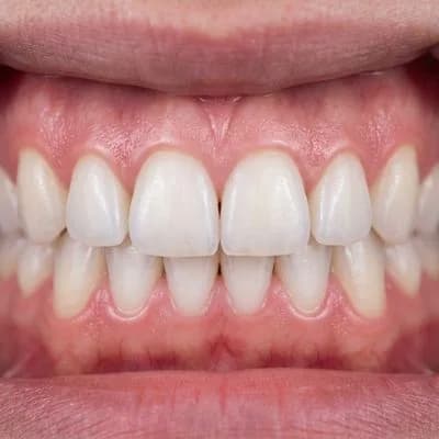 Gum Treatment After Case Study