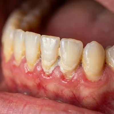 Gum Treatment Before Case Study