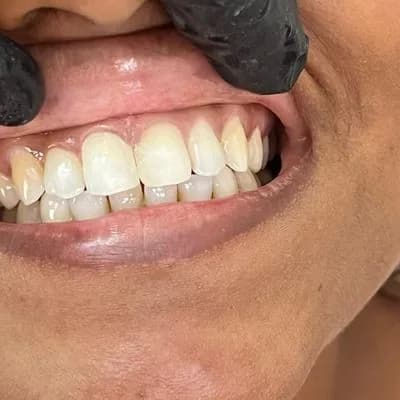 Porcelain Veneers After Case Study