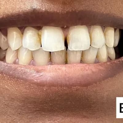Porcelain Veneers Before Case Study