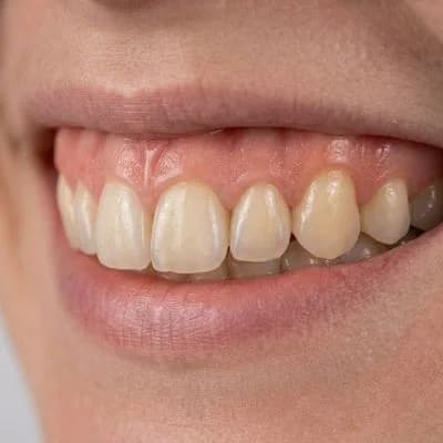 Dental Implants After Case Study