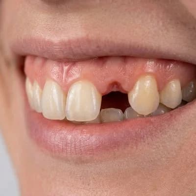 Dental Implants Before Case Study