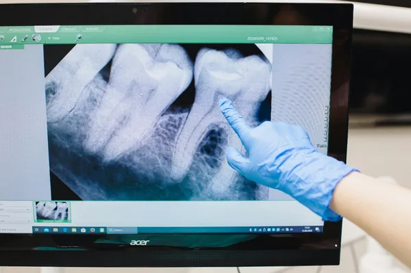 Dental Implant Cost in Lucknow: A Transparent, Complete Breakdown