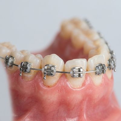Braces & Aligners Before Treatment - M.A. Dental Clinic Lucknow