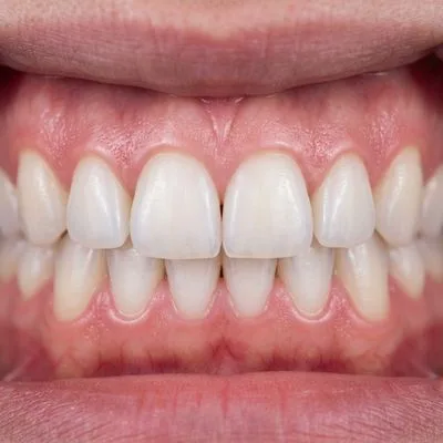 Gum Treatment After Treatment - M.A. Dental Clinic Lucknow