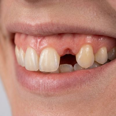 Dental Implants Before Treatment - M.A. Dental Clinic Lucknow