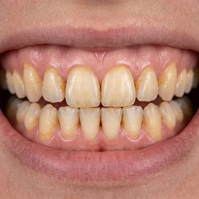 Teeth Whitening Before Treatment - M.A. Dental Clinic Lucknow