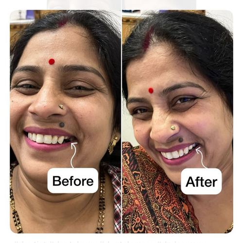 Smile Makeover Results