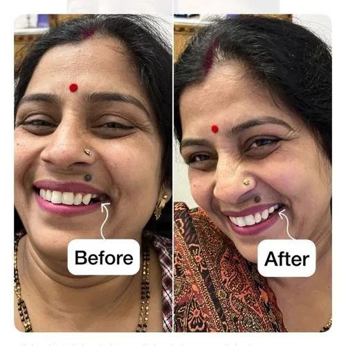 Smile Makeover Results