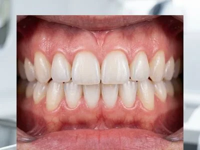 Gum Treatment
